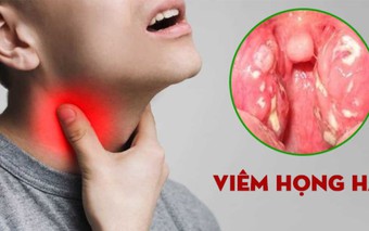 Thói quen giúp giảm triệu chứng viêm họng khi trời lạnh: Nên và không nên ăn gì để nhanh khỏi?