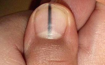Nếu móng tay có dấu hiệu này, cẩn thận với ung thư hắc tố