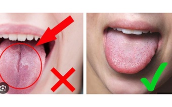 Những dấu hiệu ở lưỡi cảnh báo vấn đề sức khỏe đáng lo ngại mà nhiều người bỏ qua