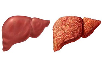 Gan 'kêu cứu' mà bạn không hay biết: 10 dấu hiệu ai cũng dễ bỏ qua