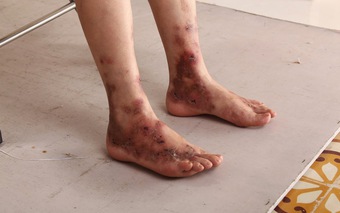 Đừng bỏ qua những thay đổi trên da: Lời cảnh báo sớm của cơ thể về viêm mao mạch hoại tử