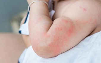 Cảnh báo: Trẻ em sốt phát ban – những dấu hiệu nhận biết sớm, cha mẹ không được chủ quan