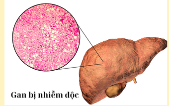 Gan nhiễm độc nguy hiểm hơn bạn nghĩ: 5 dấu hiệu thầm lặng nhiều người bỏ qua