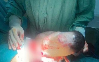 Người mẹ hạnh phúc đón em bé 3,4kg khỏe mạnh, chào đời trong 'bọc điều' hiếm gặp