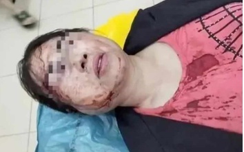 Công an vào cuộc vụ chồng đánh vợ nhập viện cấp cứu