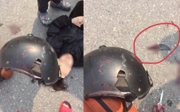 Cô gái ở Hà Nội bị mảnh vỡ của mũ bảo hiểm cắt vào đầu sau va chạm với xe ba gác