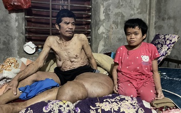 MS 1058: Người đàn ông có khối u khổng lồ đau xót nhìn vợ con lay lắt vì bệnh tật