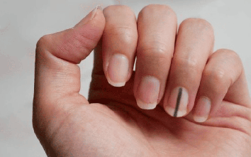 Móng tay nổi sọc dọc báo động nguy hiểm? Đừng chủ quan nếu thấy 4 đặc điểm này
