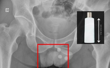 Chai nhựa dài 20cm mắc kẹt trong trực tràng người đàn ông, bác sĩ cảnh báo biến chứng nguy hiểm