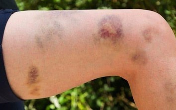 Người phụ nữ 40 tuổi đang khỏe mạnh bỗng nguy kịch sau 2 tháng mắc sai lầm này khi dùng thuốc