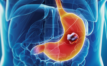 Người phụ nữ 55 tuổi mắc ung thư dạ dày giai đoạn 4 gặp may mắn: Cơ hội điều trị tốt sau ca mổ