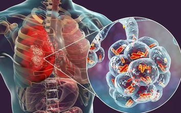 Người đàn ông 60 tuổi phát hiện sớm ung thư phổi hiếm gặp nhờ làm 1 việc mà nhiều người Việt bỏ qua