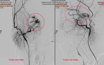 Người phụ nữ 65 tuổi phát hiện dị dạng mạch máu não từ dấu hiệu nhiều người Việt bỏ qua