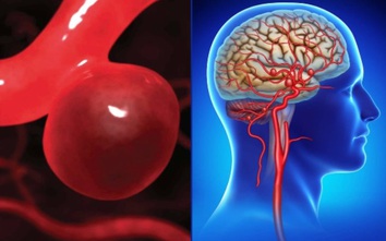 Đau đầu, buồn nôn kéo dài, người phụ nữ 44 tuổi bất ngờ phát hiện phình động mạch não