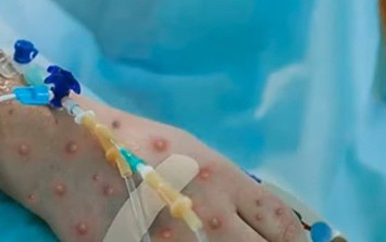 Nóng: Bệnh nhân đầu tiên mắc đậu mùa khỉ tại Việt Nam là nữ, khởi phát bệnh khi đang đi du lịch