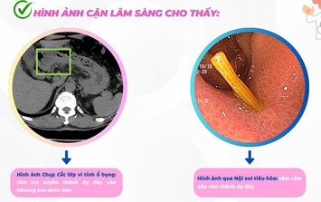 Người đàn ông ở Hải Phòng bị thủng dạ dày, thừa nhận một sai lầm mà nhiều người Việt mắc phải