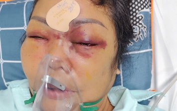 Nâng mũi cải vận nhận lại nỗi đau (bài 2): Nhân vật bảo 'có', chủ cơ sở thẩm mỹ nói 'không liên quan'