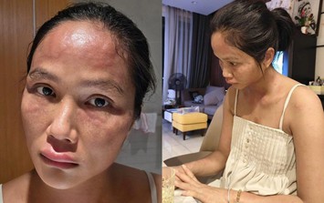 Hoa hậu H'Hen Niê bất ngờ chia sẻ mặt sưng nề, mẩn đỏ sau sinh con, căn bệnh cô mắc nguy hiểm thế nào?