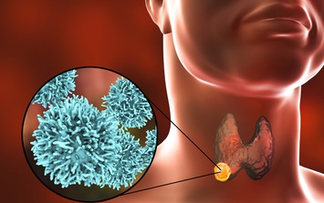 Người đàn ông 44 tuổi đang khỏe mạnh, tình cờ phát hiện ung thư tuyến giáp từ 1 việc nhiều người Việt bỏ qua