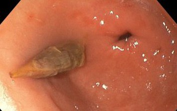 Ăn yến chưng táo đỏ, người phụ nữ 52 tuổi ở Quảng Ninh nhập viện gấp vì bất cẩn