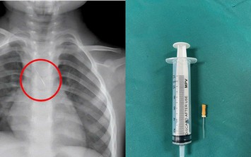 Bé 3 tuổi ở Quảng Trị bị kim chọc tủy kẹt trong đường thở