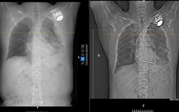 Đi khám vì đau ngực, người đàn ông 58 tuổi bất ngờ phát hiện tràn dịch màng phổi