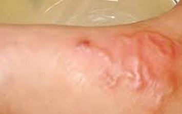 Nhiều trường hợp ở Khánh Hòa bị sán chó, người dân chủ động phòng bệnh