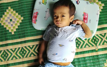 MS 1054: Xót xa hoàn cảnh bé trai bị teo mật bẩm sinh, mẹ sẵn sàng hiến gan cứu con nhưng không đủ kinh phí điều trị