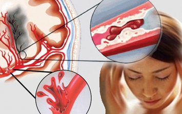 Cô gái 22 tuổi bị đột quỵ xuất huyết não, từng xuất hiện dấu hiệu này nhưng đã bỏ qua