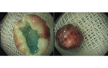 Người phụ nữ 32 tuổi bất ngờ phát hiện u thần kinh nội tiết từ một việc nhiều người Việt bỏ qua