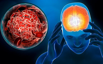 Người phụ nữ đột quỵ lúc nửa đêm có biểu hiện trước 10 ngày, nhưng dấu hiệu này nhiều người Việt rất dễ bỏ qua