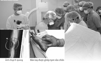Chuyện lạ: Thai phụ được bác sĩ ghép tạm bàn tay vào cẳng chân chờ ngày nối lại