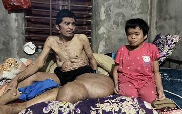 MS 1058: Người đàn ông có khối u khổng lồ đau xót nhìn vợ con lay lắt vì bệnh tật