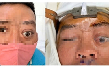 Một ca bệnh mà Bệnh viện Tai Mũi Họng TPHCM mới gặp lại trong vòng 20 năm