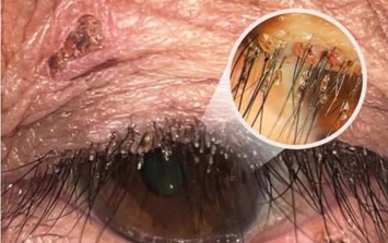 Đi khám vì cộm và ngứa mắt, bất ngờ phát hiện rận mu bám chi chít trên lông mi