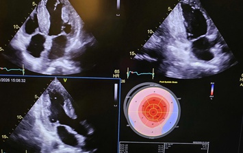 Phẫu thuật ghép tim và gan thành công cho bệnh nhân mắc bệnh hiếm