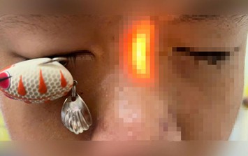 Bé trai 13 tuổi đi cấp cứu với lưỡi câu ghim sâu trong mắt