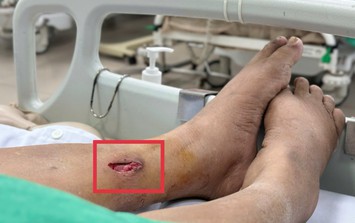 Vết thương do thanh tre đâm vào chân đã liền, người phụ nữ bất ngờ nguy kịch vì nguyên nhân này