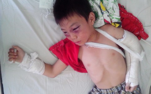 Đánh con riêng “vợ hờ” đến nứt sọ ở TP Hồ Chí Minh: Đổ lỗi cho… rượu