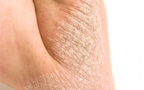 Hỏi và đáp về bệnh vảy nến
