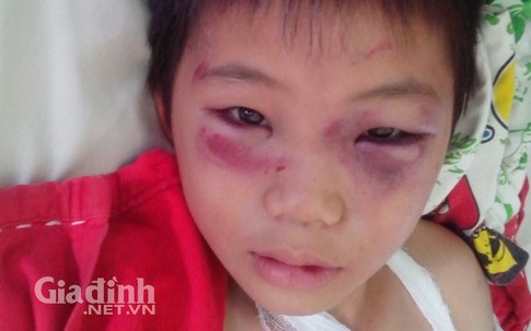 Bé trai bị bố dượng đánh chấn thương sọ não, gãy 2 tay 1 chân