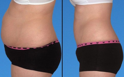 Chọn cách nào để giảm cân hợp lý?