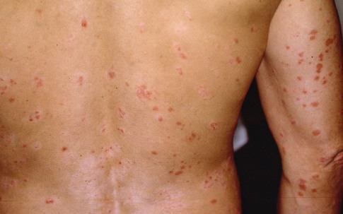 Vẩy nến có lây không?