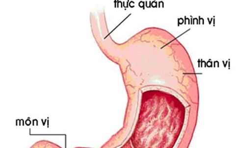 Cảnh giác với bệnh viêm loét hang vị dạ dày