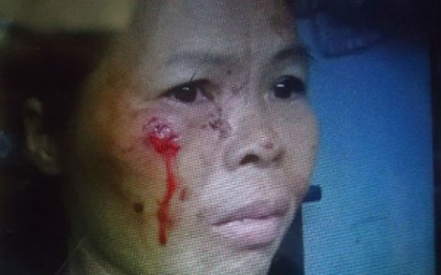 Nàng dâu hung dữ cắn tai, móc mắt người nhà như “ma cà rồng"