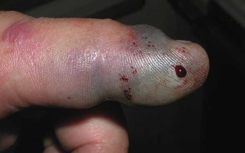 Bộ Y tế  chỉ đạo về điều trị bệnh nhân bị rắn lục đuổi đỏ cắn