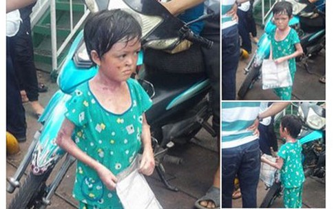 Sự thật câu chuyện bé gái "bị tạt nước sôi gây lở loét để bắt đi ăn xin ở An Giang"