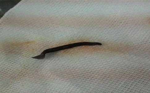 Kinh hãi đỉa dài gần 5cm bám sâu trong lỗ mũi