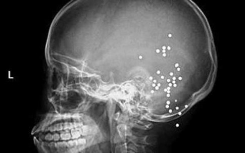 Bé 2 tuổi bắn 35 viên đạn bi sắt vào đầu mẹ