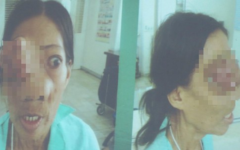 Cứu sống người phụ nữ bán vé số bị u xâm lấn não